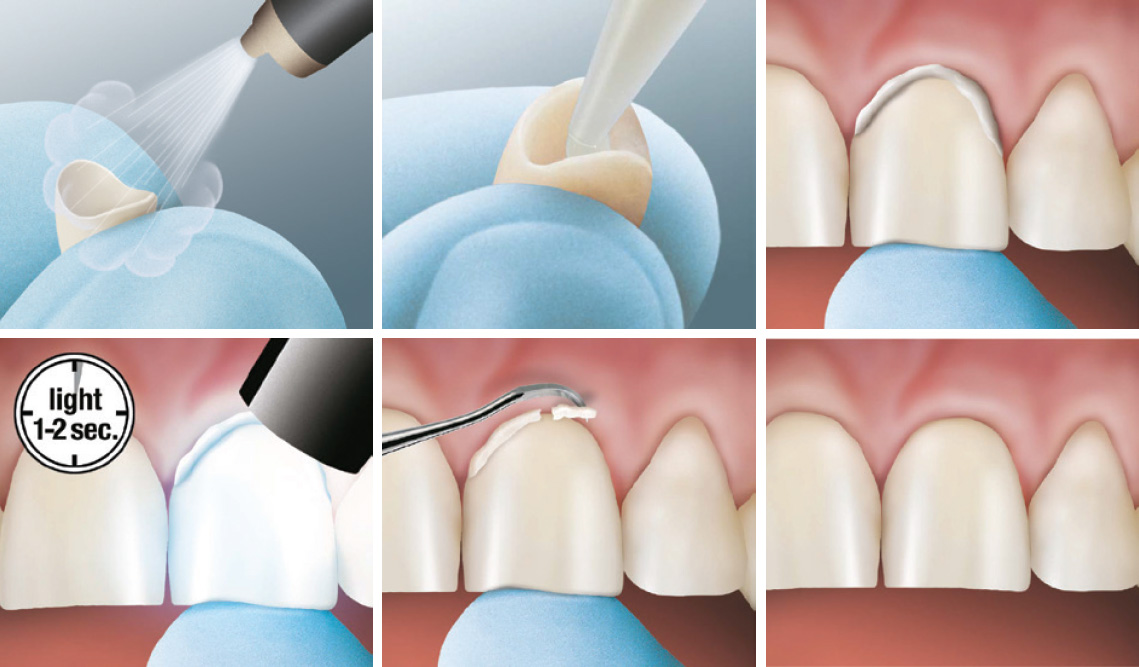 Simplificando a Cimentação - Dental Express